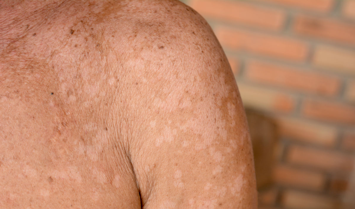 Discussion on this topic: What Is Tinea Versicolor, what-is-tinea-versicolor/ Forum on this topic: What Is Tinea Versicolor, what-is-tinea-versicolor/