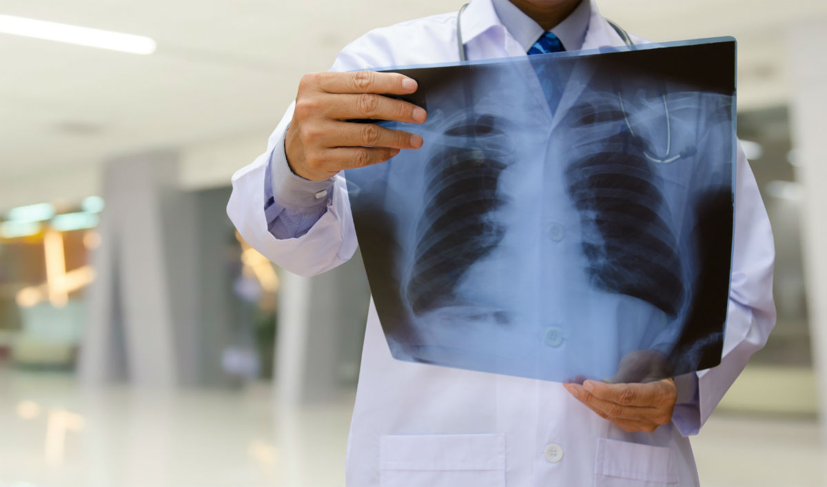 6 Sneaky Signs Of Lung Cancer That Have Nothing To Do With A Cough 6 Sneaky Signs Of Lung Cancer That Have Nothing To Do With A Cough
