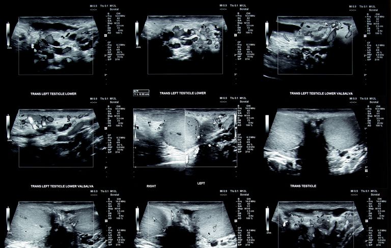 slide-6-testicular-cancer-exam-1519752645.jpg slide-6-testicular-cancer-exam-1519752645.jpg